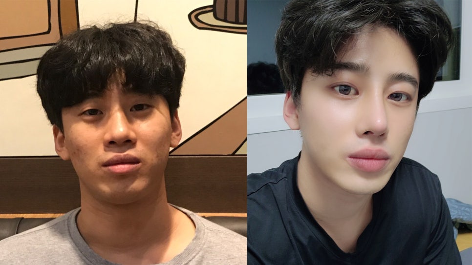 남자눈재수술 어디서 해야 할까? 관련 이미지 2