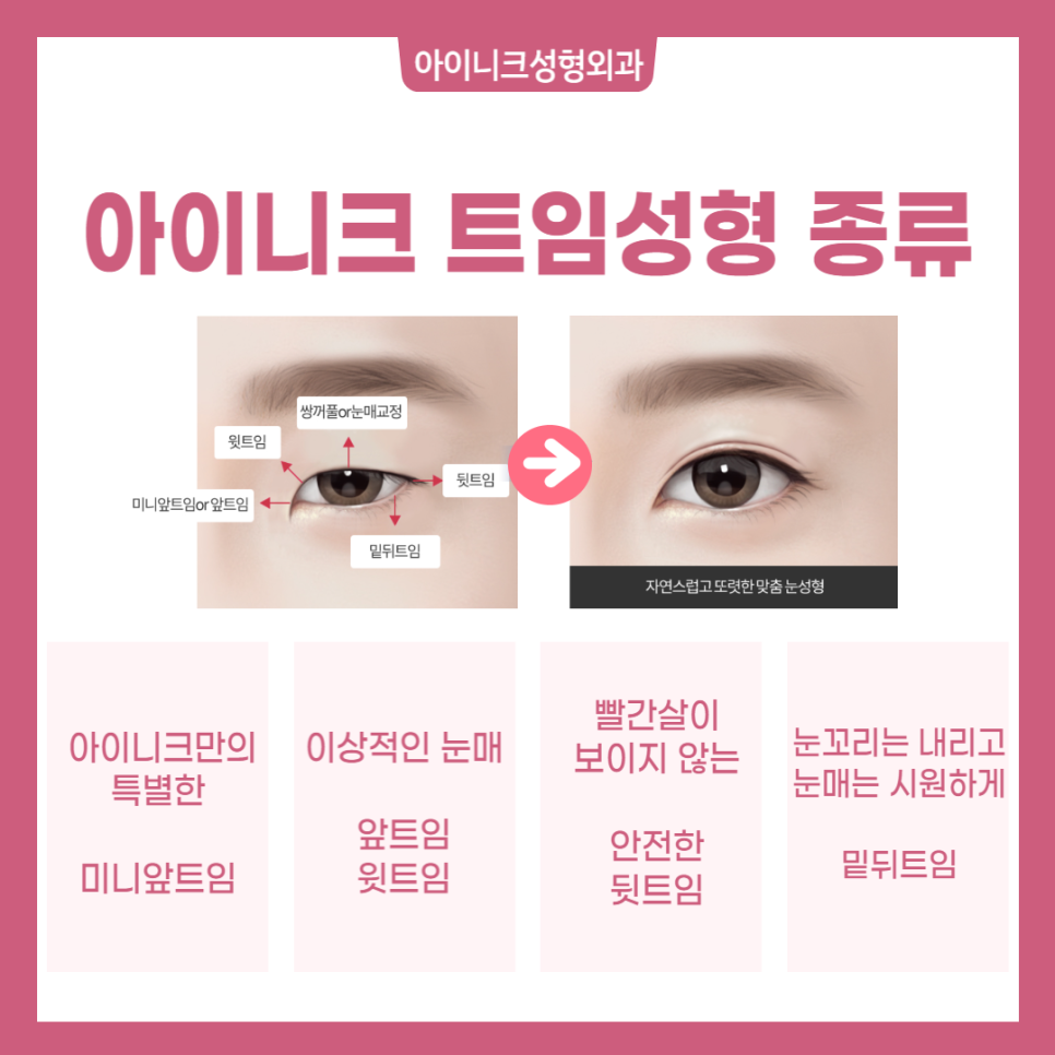 Blepharoplasty for Large, Beautiful Eyes image 2