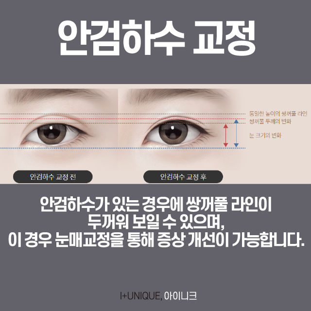 서울눈재수술추천 아이니크 성형외과에서 제대로 성공하자. 관련 이미지 2