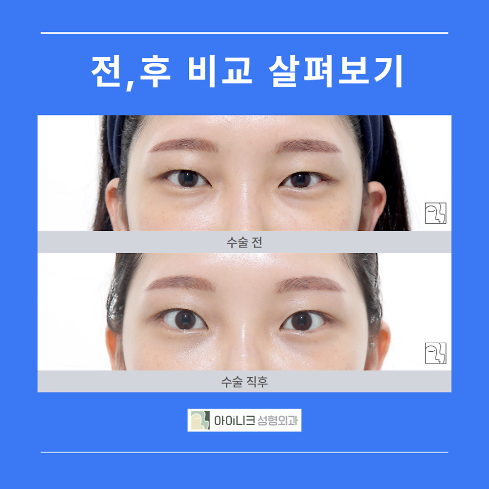 눈밑지방성형외과 찾기 어렵지 않아요 관련 이미지 5