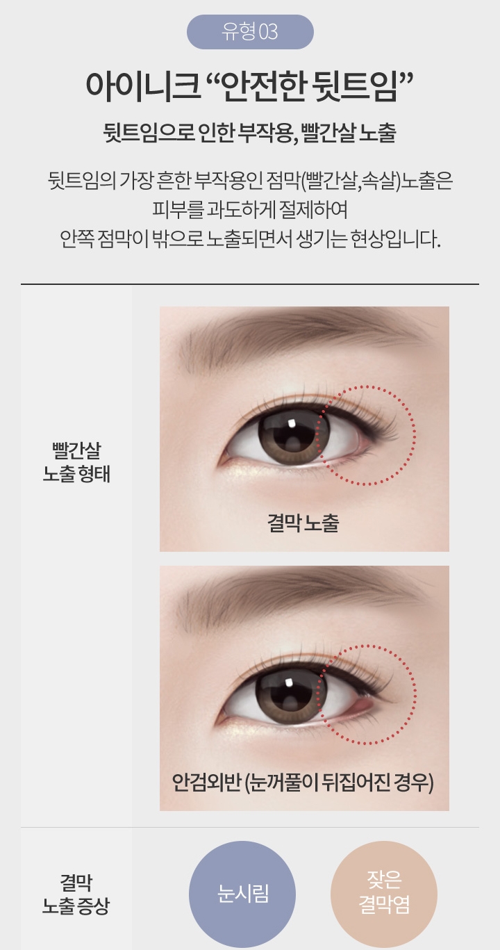 눈앞뒤트임 또렷한 눈매로 변신! 관련 이미지 6