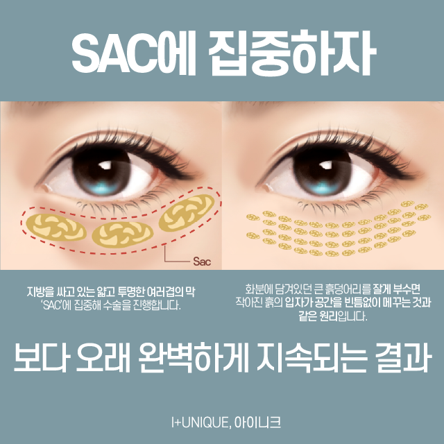 눈밑지방수술추천, 오늘 수술해도 내일 회복 가능한 바로 그것! 관련 이미지 2