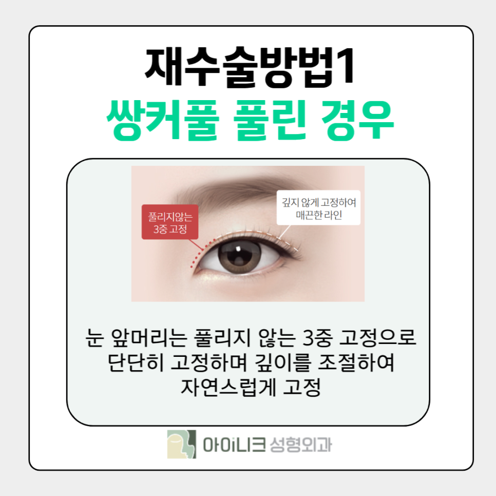 If You’re Curious About How to Fix Multiple Eyelid Folds image 3