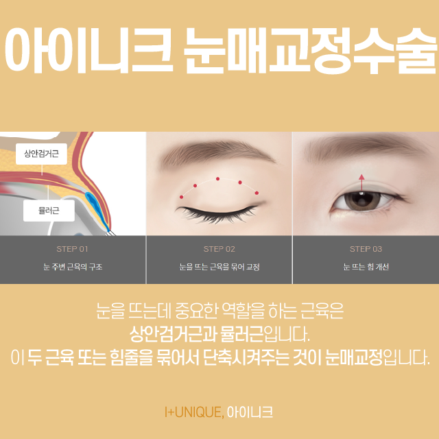 눈매교정수술, 당신이 안검하수라면 비절개눈매교정에 주목하세요. 관련 이미지 4
