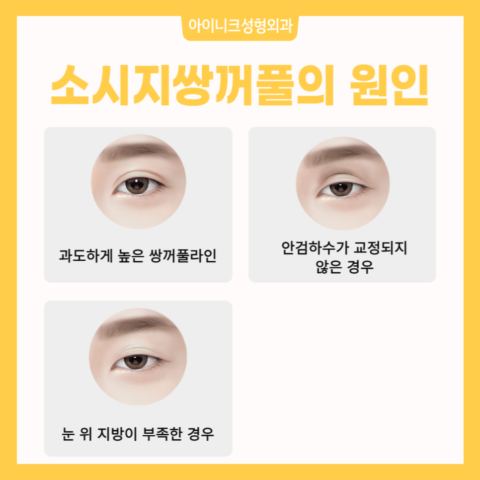 Creating Natural-Looking Eyes with Double Eyelid Line Revision Surgery image 2