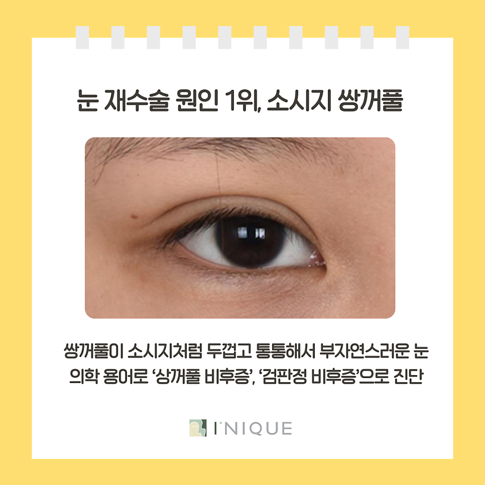 압구정 눈재수술 결정하기 전 꼭 체크할 네가지! 관련 이미지 5