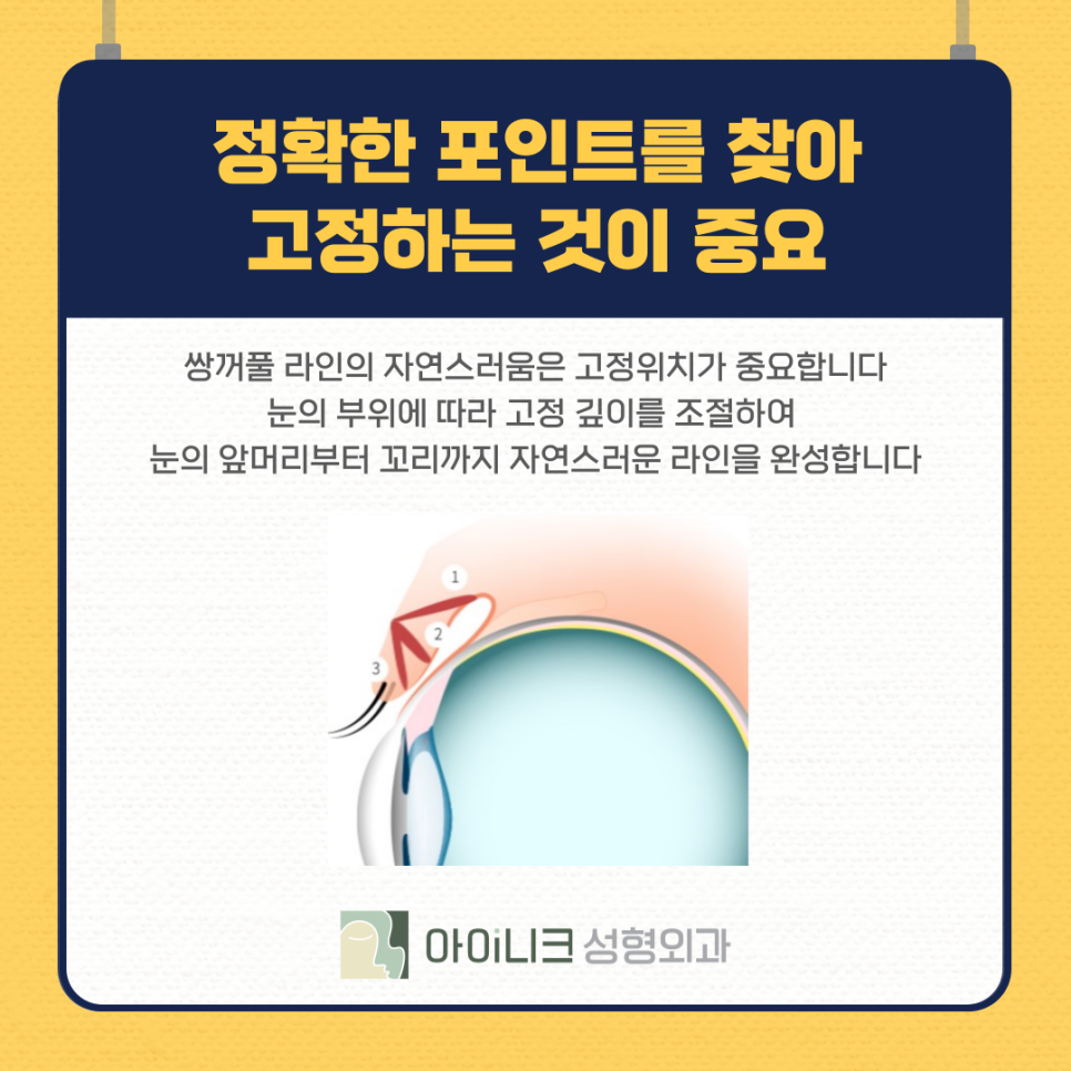쌍수잘하는병원 실패없이 잘 선택하려면 관련 이미지 10