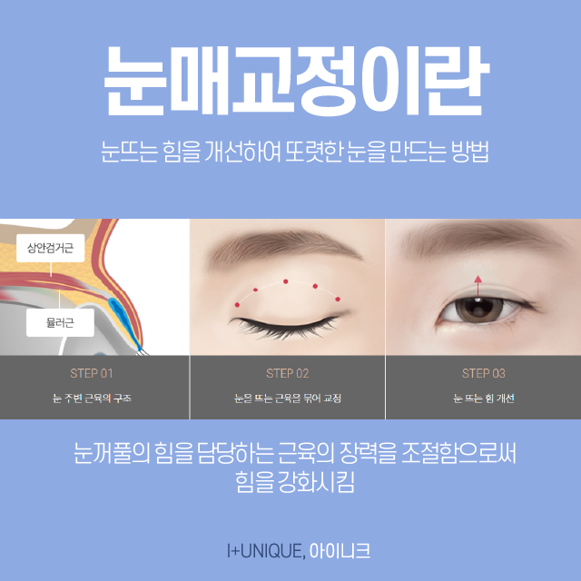 서울눈매교정 반드시 해야할까요? 관련 이미지 3