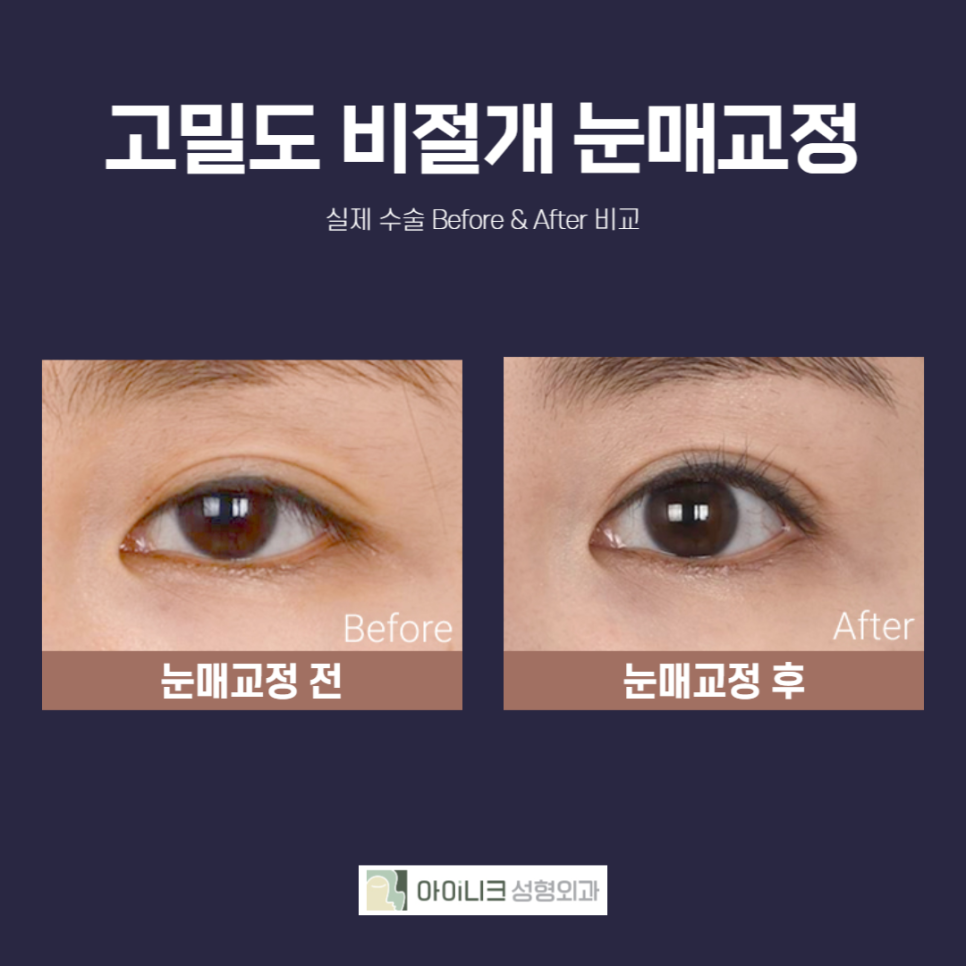 Recommended Eye Surgery! Two Procedures with Less Scarring and Faster Recovery image 3