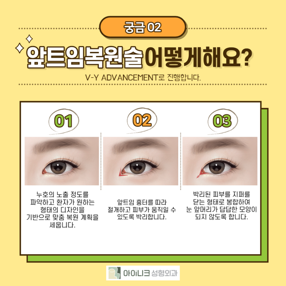 Let’s Take a Proper Look at Revision Eye Surgery! image 3