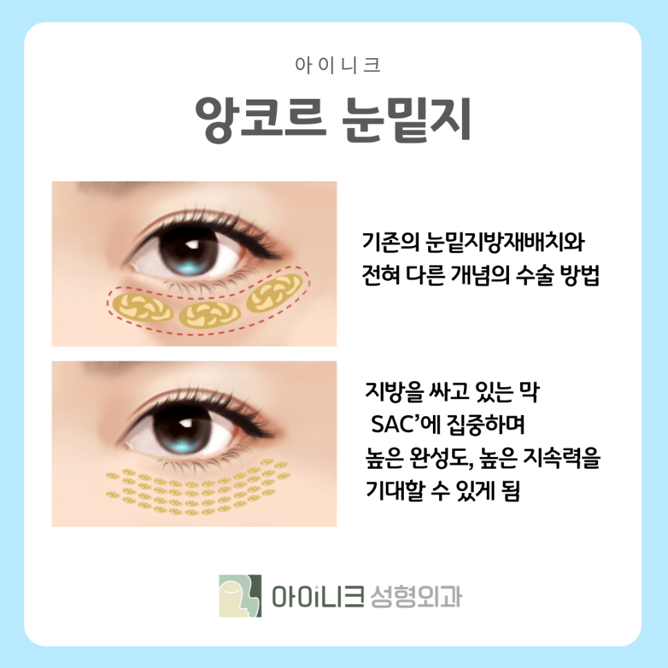 압구정 앙코르눈밑지 다크서클 개선하기 관련 이미지 6