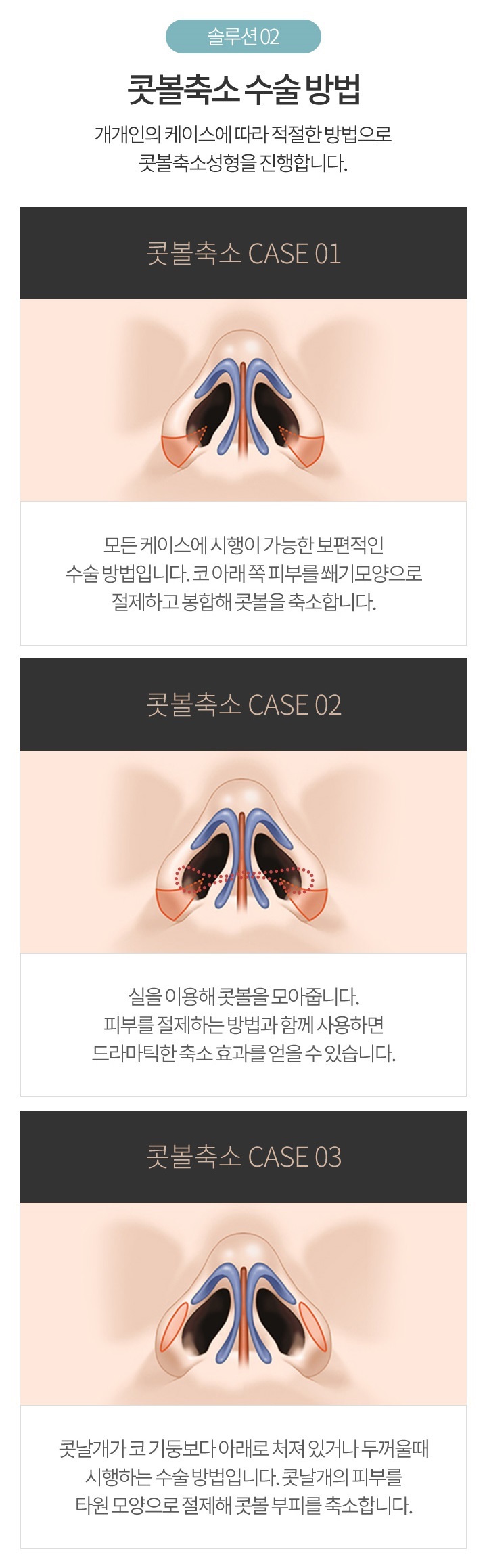 콧볼축소술비용 만족스러운 결과로 보답하는 곳! 관련 이미지 5
