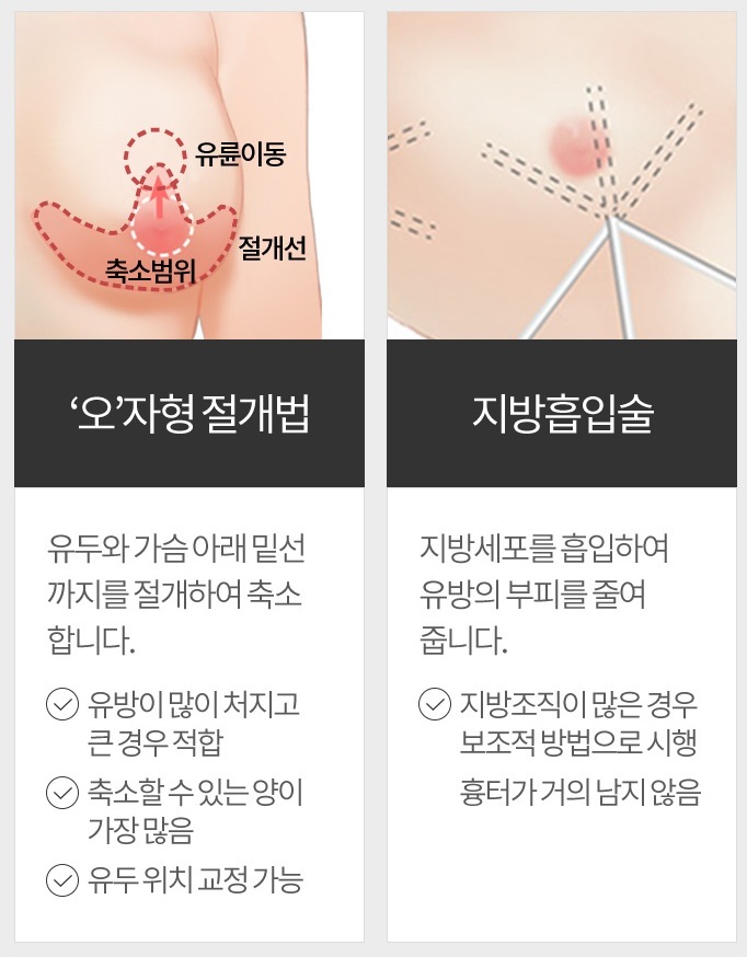 가슴축소술 자연스러운 내 가슴을 위해 관련 이미지 4