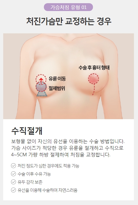 가슴처짐수술비용 궁금하다면 자연스러운 아이니크로! 관련 이미지 3