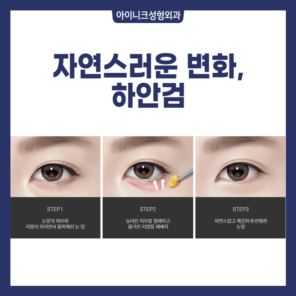 40대중년눈성형, 많이 하나요? 관련 이미지 3