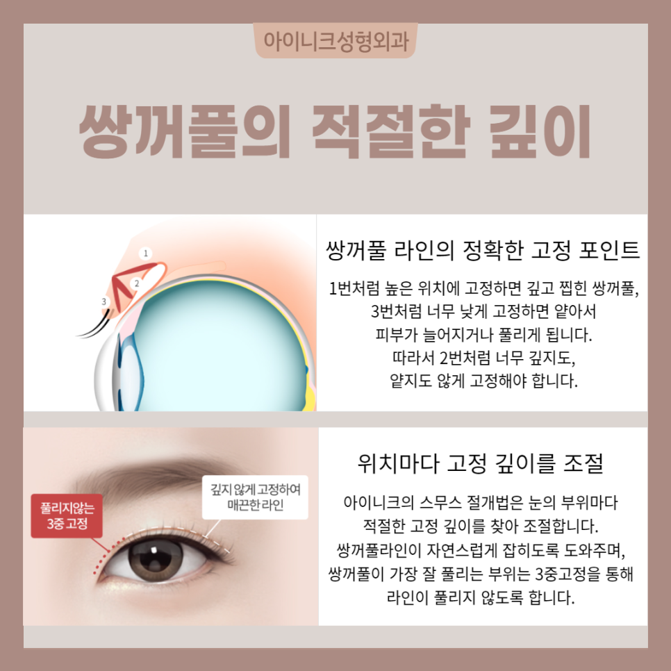 연예인눈성형처럼 자연스럽고 싶다면? 관련 이미지 4