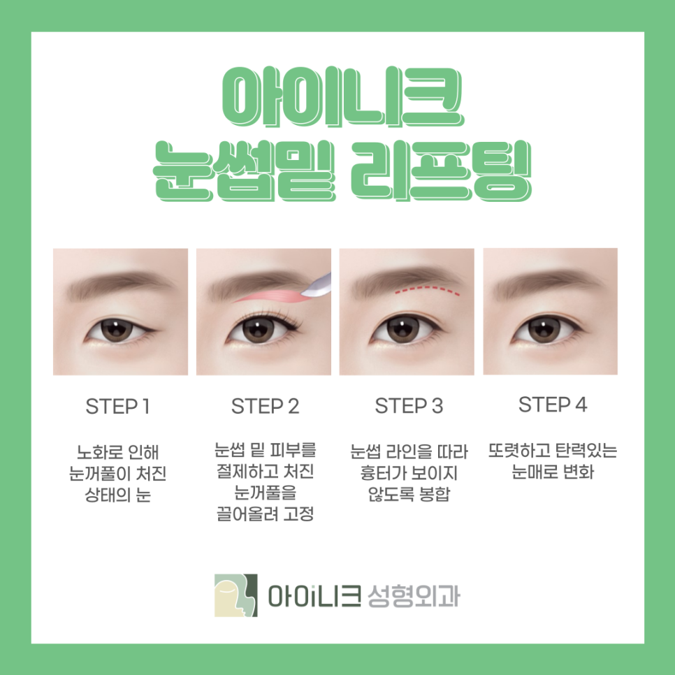 중년눈성형외과 처진 눈 개선하기 관련 이미지 5
