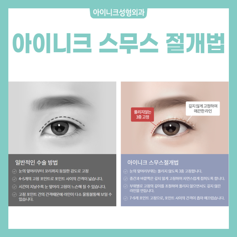 쌍꺼풀만들기 아이니크에서 알아보세요! 관련 이미지 3