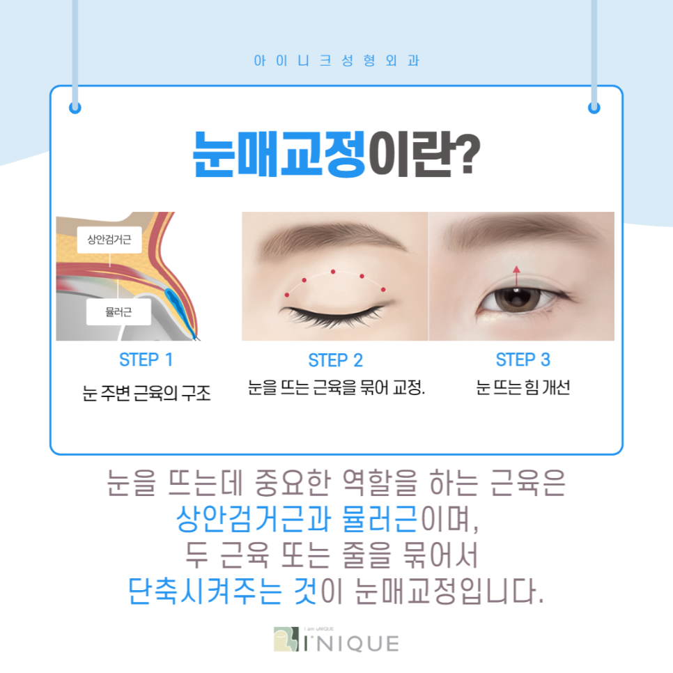 눈매과교정, 부작용을 예방하려면? 관련 이미지 2