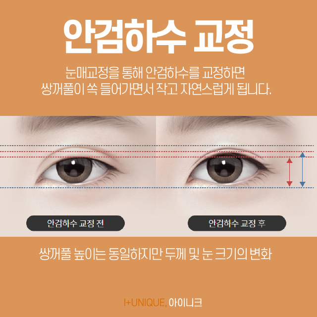 쌍꺼풀재수술병원 알아보고 있다면 경험많은 곳을 선택해야죠 관련 이미지 4