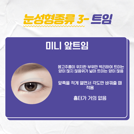 눈성형종류 중에 내게 맞는 방법은? 관련 이미지 4