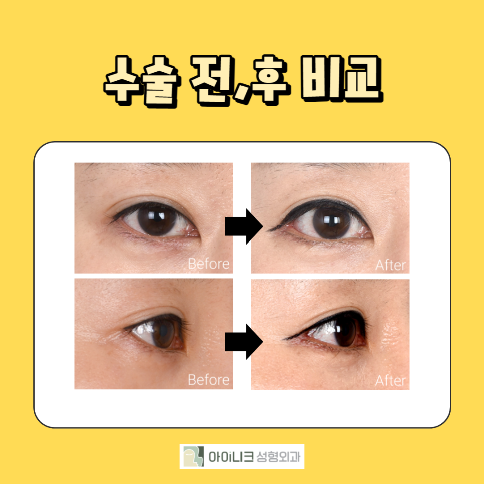 뒷트임밑트임 하기 전 조심해야 할 것은? 관련 이미지 5