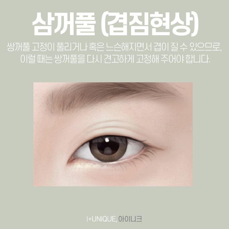 눈재성형을 고민하고 있다면, 믿을 수 있는 아이니크성형외과에서 관련 이미지 4