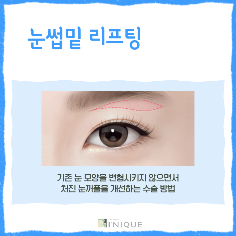 For a Brighter, More Youthful Impression with Midlife Eye Surgery image 3
