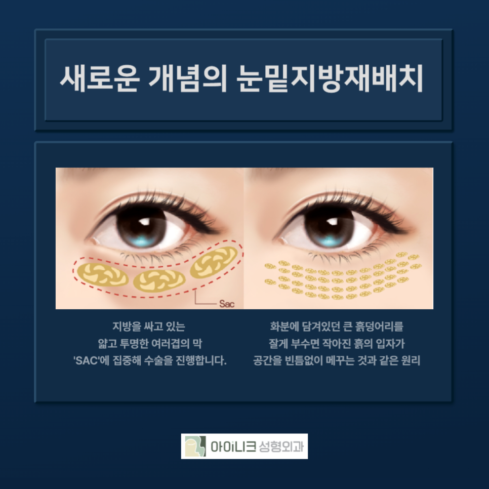 다크서클제거수술, 보다 확실한 방법으로 관련 이미지 2