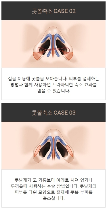 콧볼지방제거 세련된 이미지로 변신 관련 이미지 5