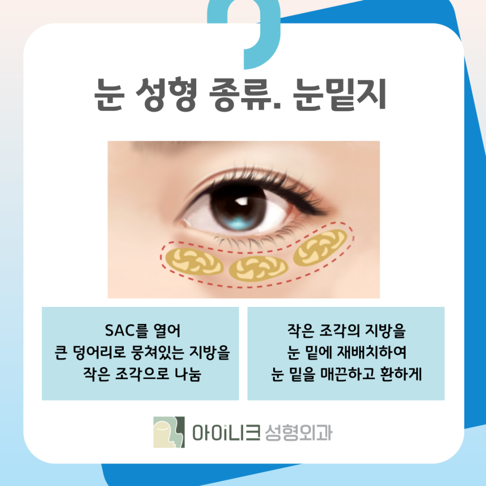 강남성형외과유명한곳 눈 성형 종류가 궁금해요 관련 이미지 8
