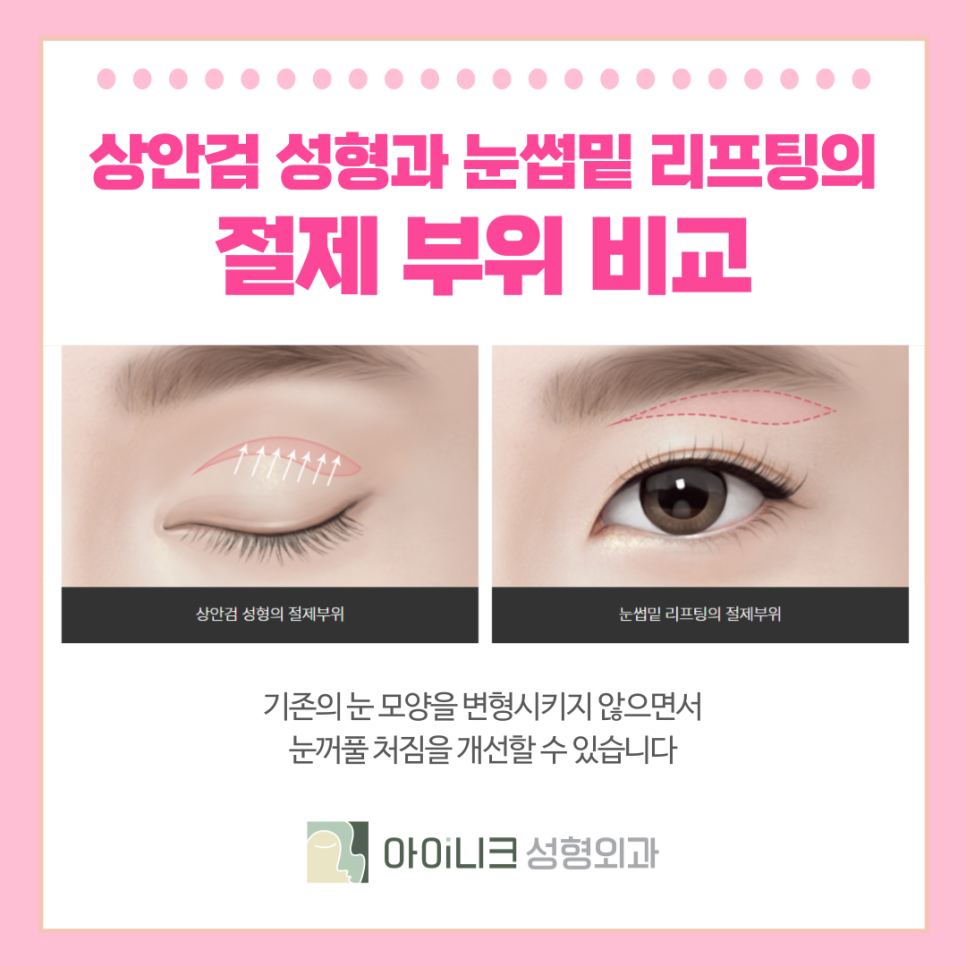 압구정 중년눈성형 시간을 되돌리고 싶다면? 관련 이미지 5