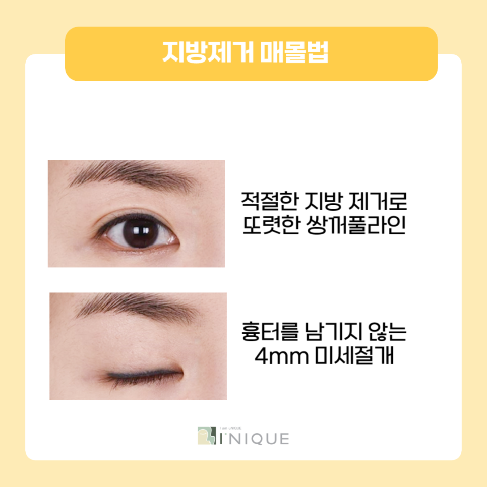 The Best Place for Double Eyelid Surgery for Women Is Right Here! image 4