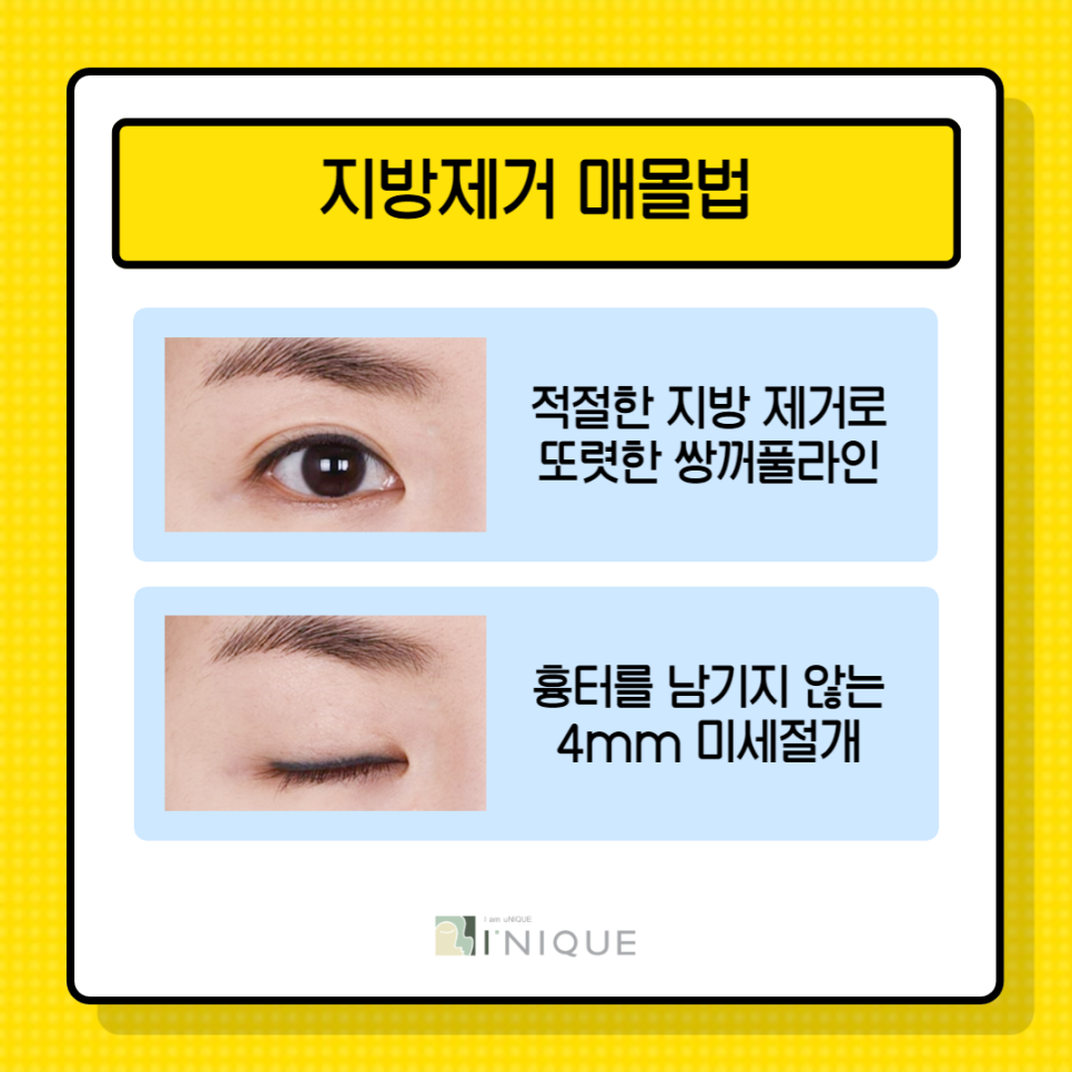 강남쌍수잘하는곳은 뭐가 다를까? 관련 이미지 6