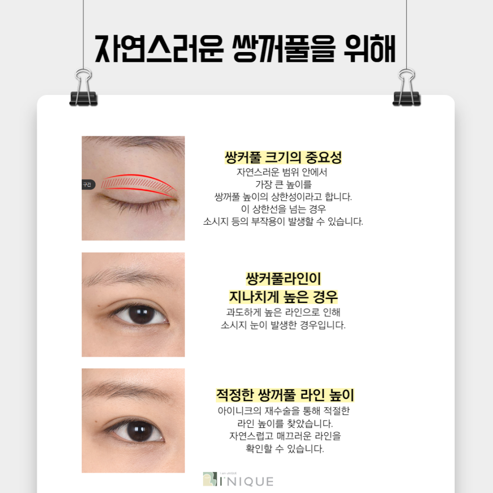 Before and After Double Eyelid Surgery, Naturally Beautiful AINIQUE image 3