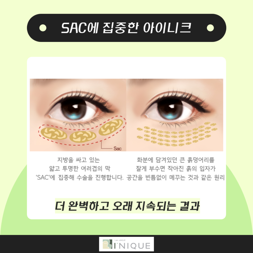 눈밑지방재배치수술로 다시 20대의 눈매로 관련 이미지 2