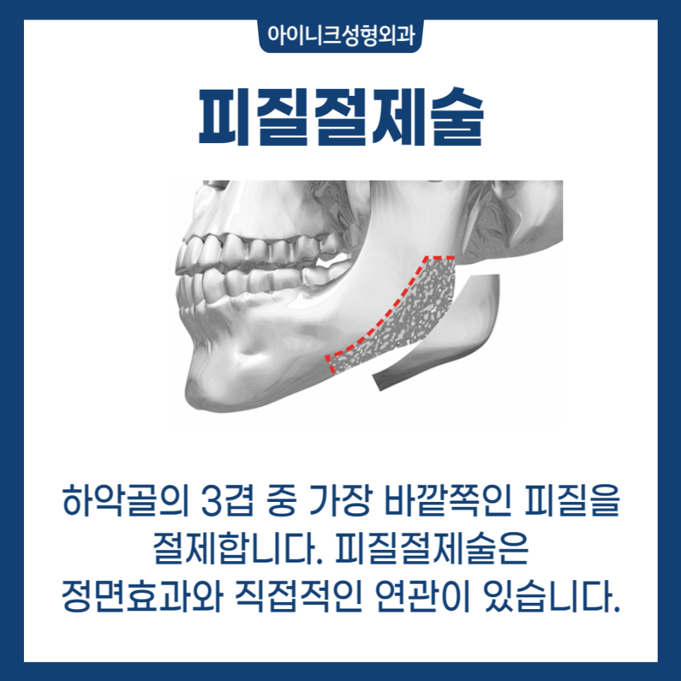 자연스러운 V라인 사각턱성형 관련 이미지 4