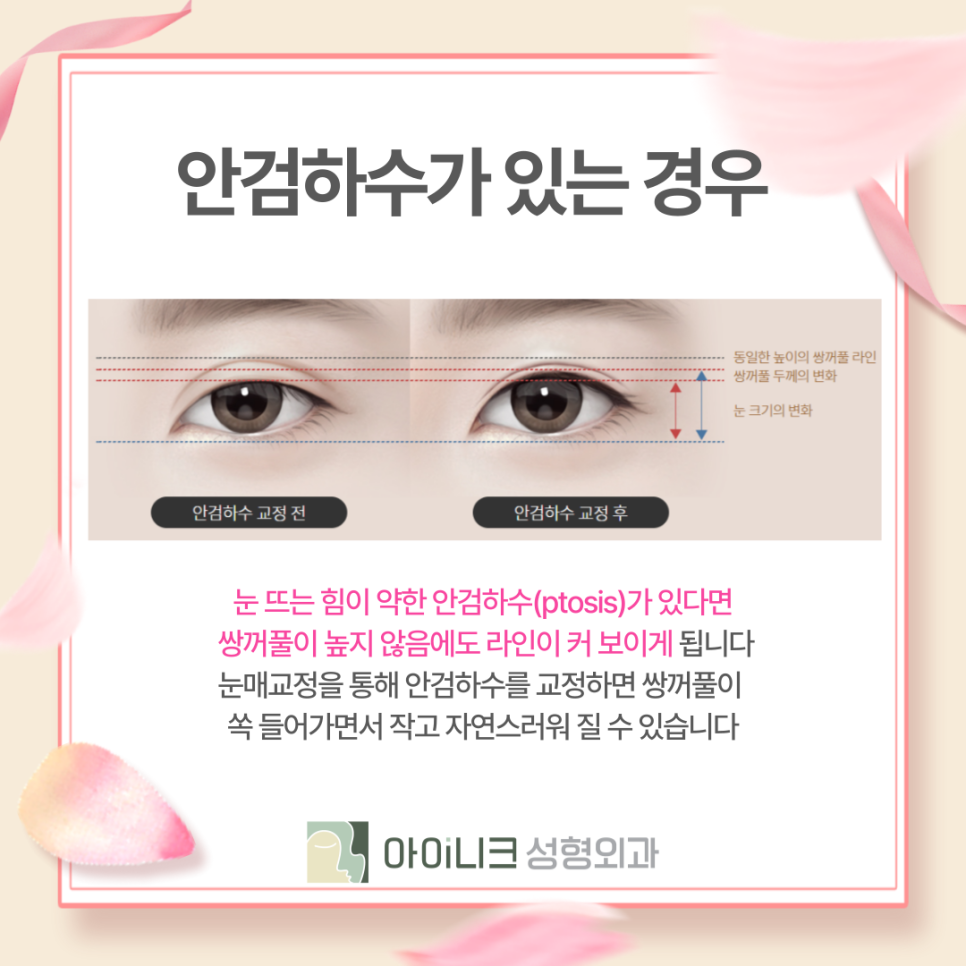 쌍수재수술병원 부담스러운 소시지눈 개선하기 관련 이미지 12