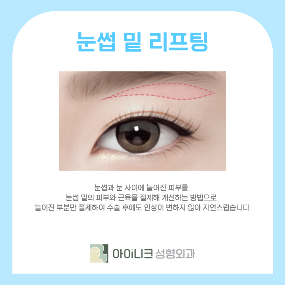 눈가리프팅 중년 눈성형으로 10년 어려보이기 관련 이미지 6