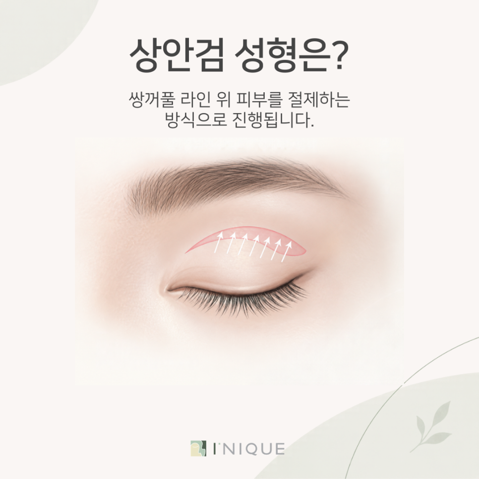 상안검수술, 권하지 않는 이유가 궁금하다면 관련 이미지 3