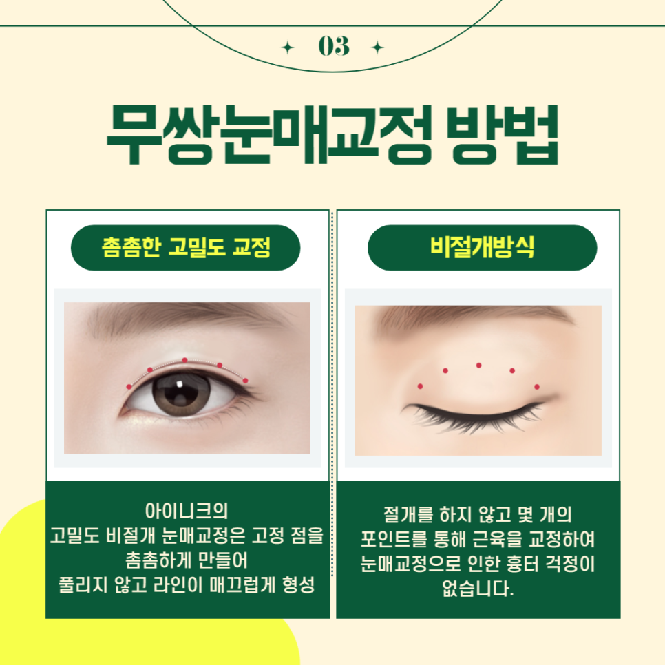무쌍눈매교정술로 티나지 않는 또렷한 눈 만들기 관련 이미지 4