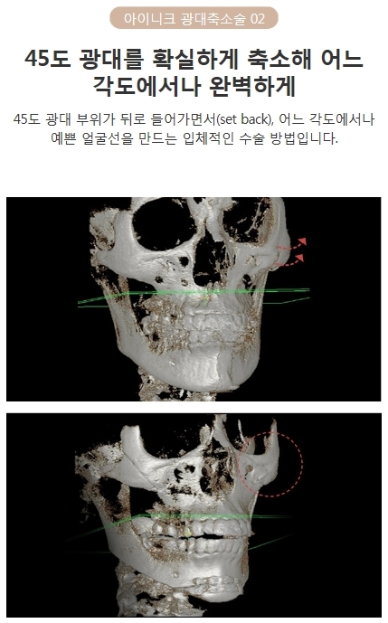 광대뼈축소부작용 없이 자연스러운 내 얼굴! 관련 이미지 5