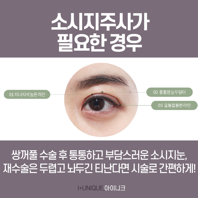 쌍수 붓기 빨리 빼는 법? 소시지 주사가 답! 관련 이미지 3