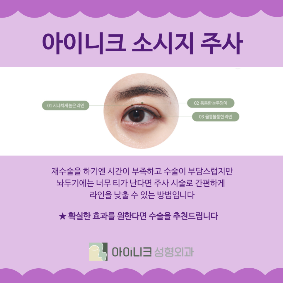 소시지쌍꺼풀 원인과 개선 방법 관련 이미지 6
