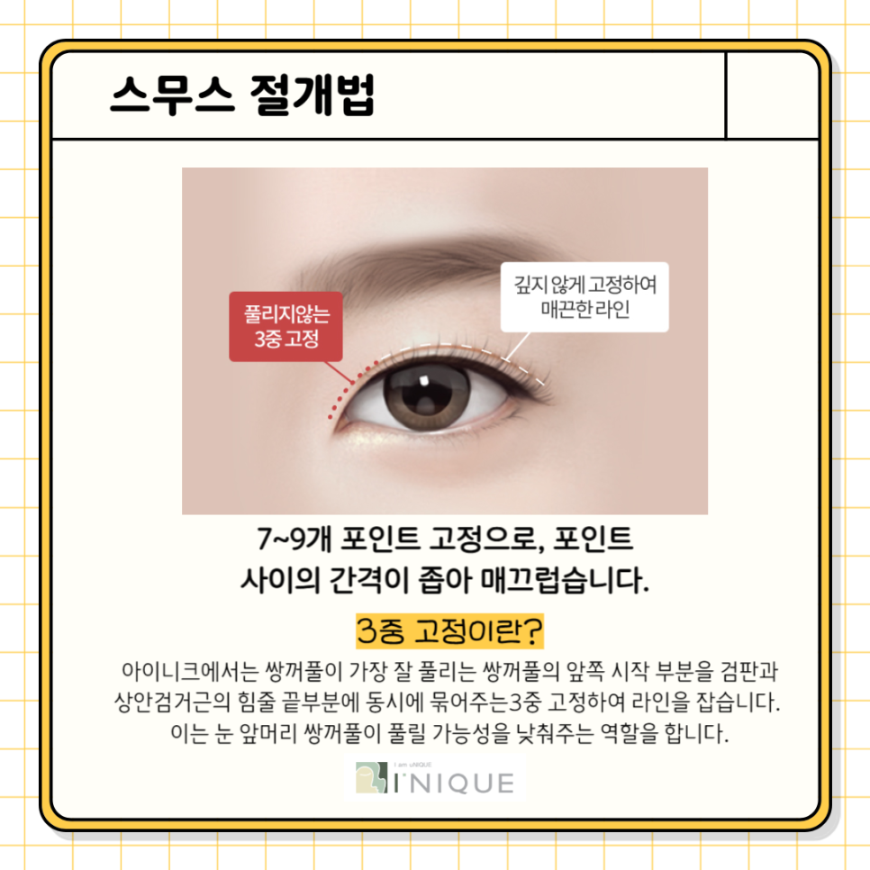 눈성형전후 확실한 변화를 원한다면 관련 이미지 5