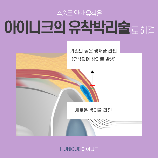 성형의 기본 쌍꺼풀 수술부터 풀린쌍꺼풀, 삼꺼풀 해결 방법까지 모두 알아보기 관련 이미지 4