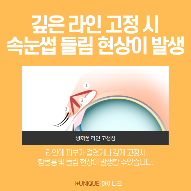 속눈썹들림 - 달라진 눈 모양 해결하기 관련 이미지 5