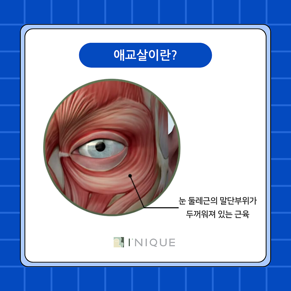 서울강남성형외과 눈수술에 대해 파헤쳐보기! 관련 이미지 4