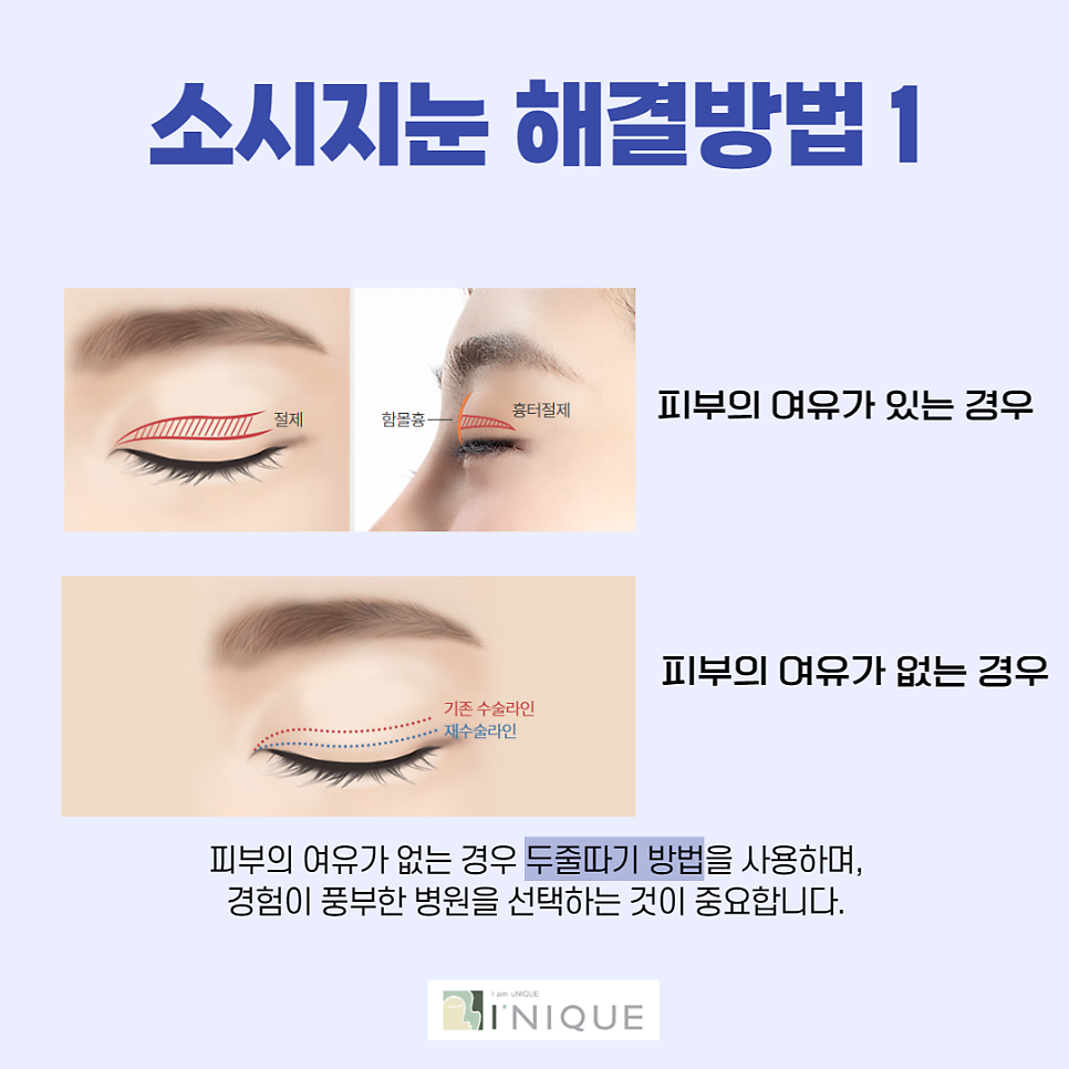 How to Naturally Lower the Double Eyelid Line image 3