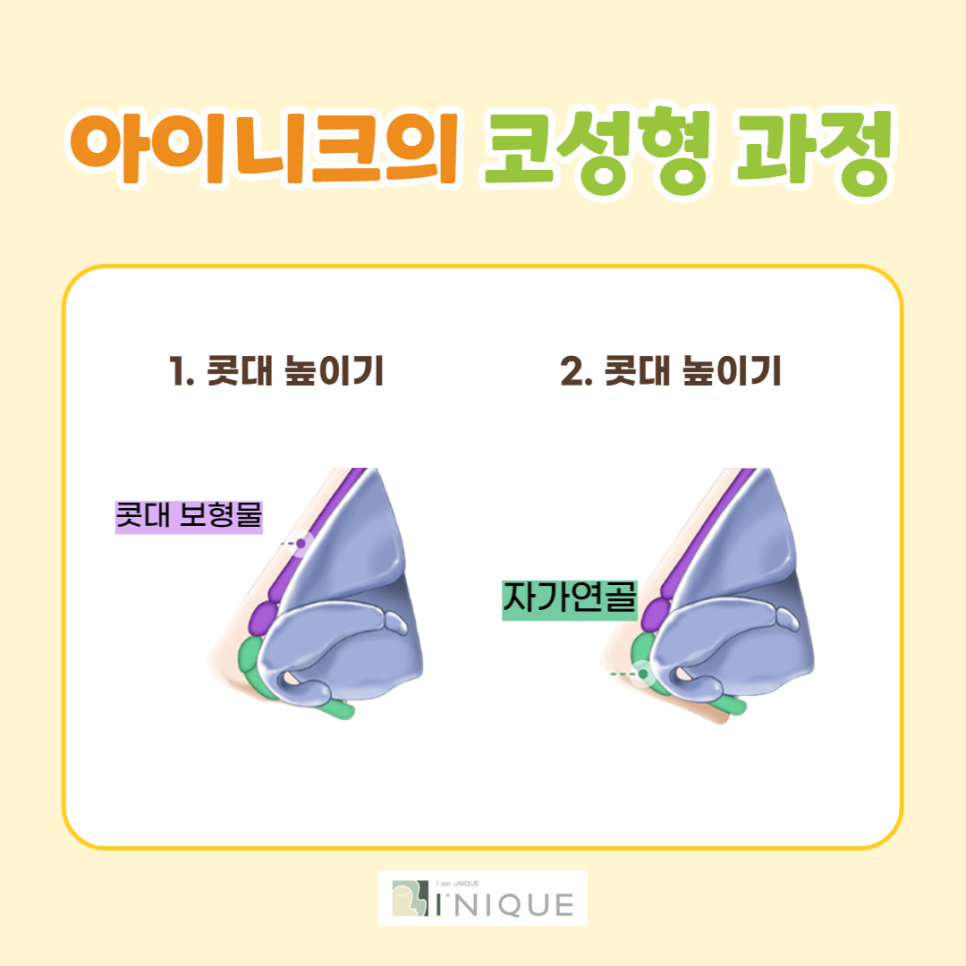 낮은코성형, 얼굴 전체를 고려해야 합니다. 관련 이미지 4